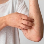 Skin Cancer Treatment Cost in India